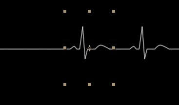 electrocardiogramme